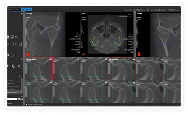 Temporal-Mandibular Joint