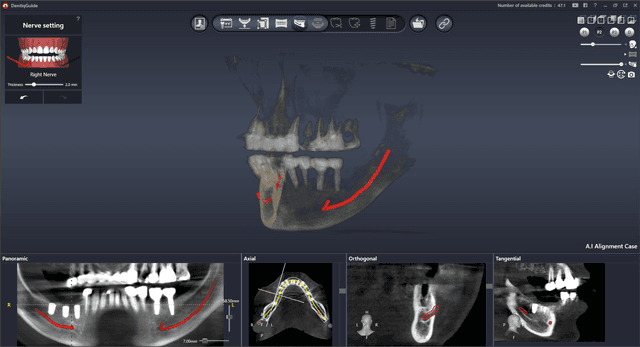 Nerve Canal Detection