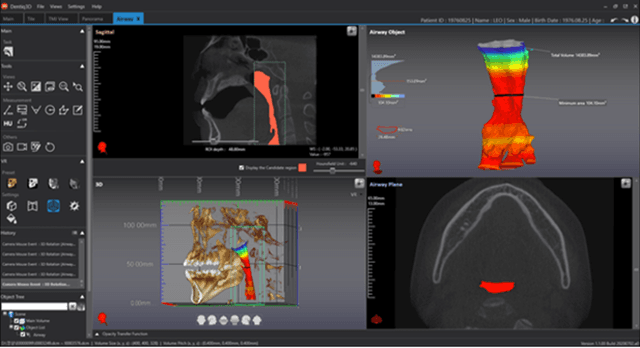 CT-Scan Data Alignment