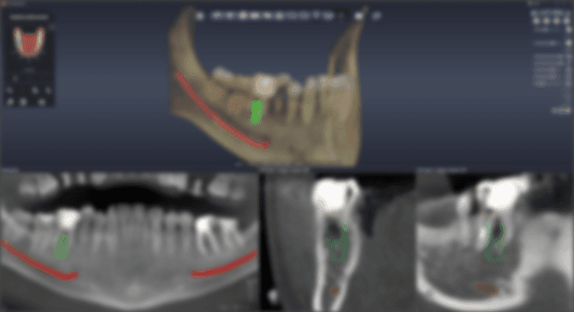 Fixture Selection & Placement